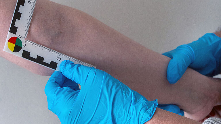 Ein Unterarm liegt ausgestreckt in zwei Händen mit blauen sterilen Handschuhen. Die linke Hand hält ein Winkellineal an die Armbeuge, wo ein blauer Fleck erkennbar ist. 