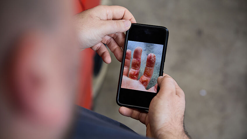 Florian Weidenweber hält ein Smartphone in der Hand, auf dem ein Foto seiner Finger mit der Hautkrankheit zu sehen ist.