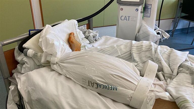Bein eines Patienten, das für die CO2-Trockenbehandlung in eine spezielle Behandlungshülle gepackt wurde.